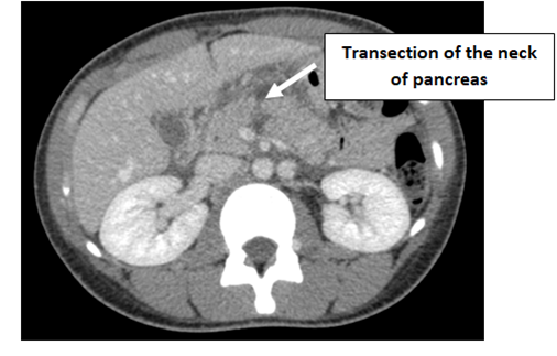 Figure 1: CT Abdomen (Porto venous phase), showing transection at the neck of the pancreas (white arrow).