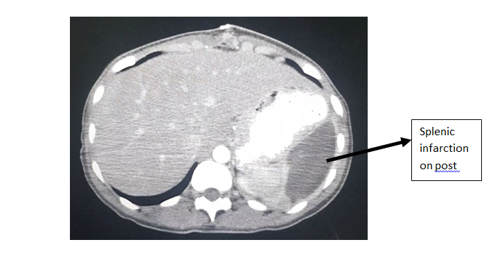Figure 3: CT Abdomen on Day 10 – showing splenic infarction (black arrow).