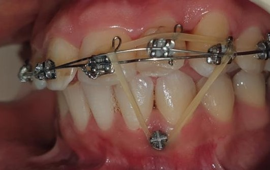 Figure 5: combined TADs traction and overlay wire after surgical luxation.