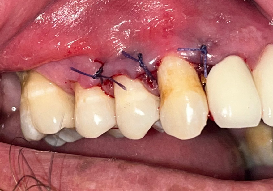 Figure 5: Coronal Advancement of Flap and Suturing.
