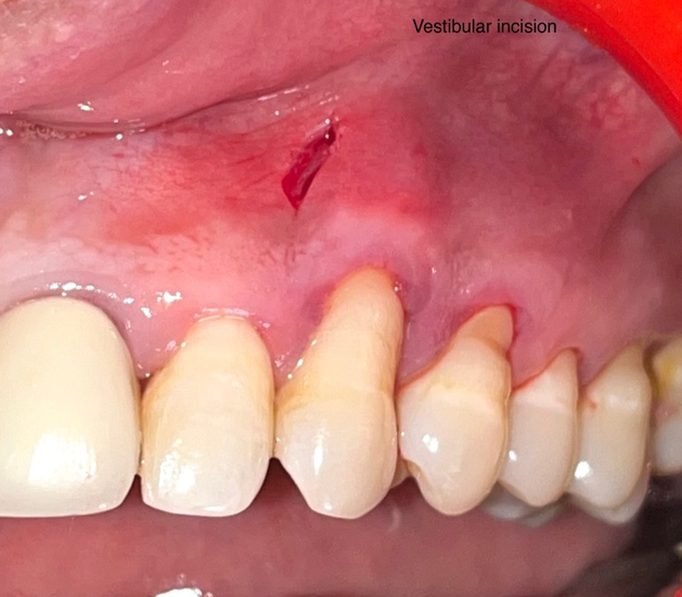 Figure 7: Vestibular Incision.