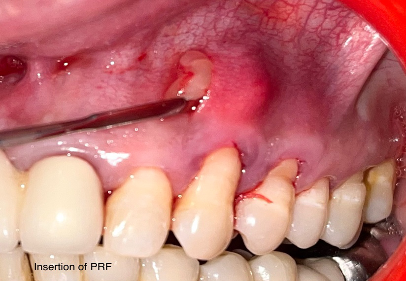 Figure 9: Placement of PRF.
