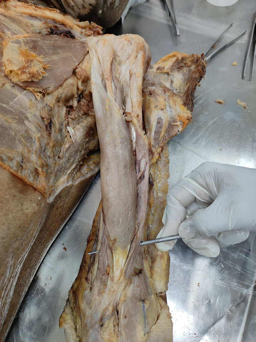 Figure 2: Showing the Photo and illustration of dissection demonstrating the 4th head along with Long head, Short head, and 3rd head and of the Biceps Brachii Muscle.