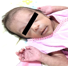 Figure 1: Image of the Neonate at Birth.