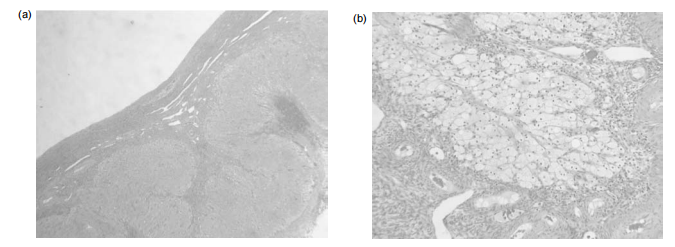 Figure 6: The histological appearances of the corpus luteum, showing (a) an active corpus luteum and (b) regression of the corpus luteum with histiocytes infiltration. (Kindly provided by Professor M Wells, University of Sheffield.)