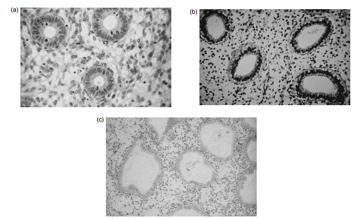 Figure 7: The histological appearances of the endometrial cycle, showing proliferative, early secretory, mid-secretory phase’s equivalent to the images a, b and c. (Kindly provided by Professor M Wells, University of Sheffield.) Therefore, in contrast to most vascular beds, which maintain a determined structure throughout their existence, the endometrial vascular network evolves and regresses during each brother-stroll era. Numerous angiogenic and angiostatic factors have been identified in the human endometrium. Most some of these studies have focused on vascular endothelial progress determinants (VEGF) and interleukins that grant permission to be straightforwardly compassionate to varying concentrations of ovarian steroids.