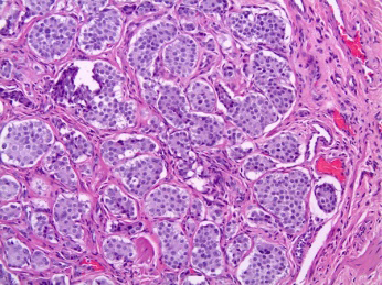 Figure 1: Neuroendocrine tumour delineating solid areas and trabecular pattern comprised of monomorphic cells imbued with abundant eosinophilic cytoplasm and salt and pepper nuclear chromatin. Surrounding stroma is fibrous and vascularized.