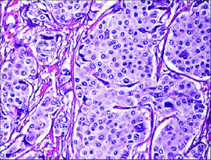 Figure 2: Neuroendocrine tumour exhibiting solid foci and trabeculae composed of monomorphic cells incorporated with abundant eosinophilic cytoplasm and fine nuclear chromatin. Circumscribing stroma is fibrotic and vascularized.