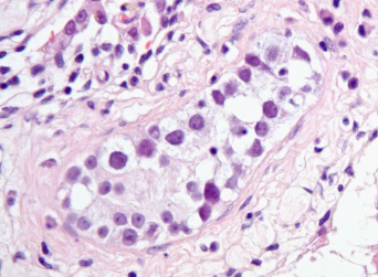 Figure 2: Germ cell neoplasia in situ delineating enlarged, atypical cells incorporated with abundant cytoplasm, enlarged, hyperchromatic nuclei, coarse nuclear chromatin and prominent nucleoli. Neoplastic cells coat the basement membrane of seminiferous tubules.
