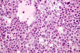 Figure 2: Spermatocytic tumour constituted of triphasic cellular component as small, intermediate and giant cells intermingled with fluid filled spaces and traversed by fibrous tissue septa [8].