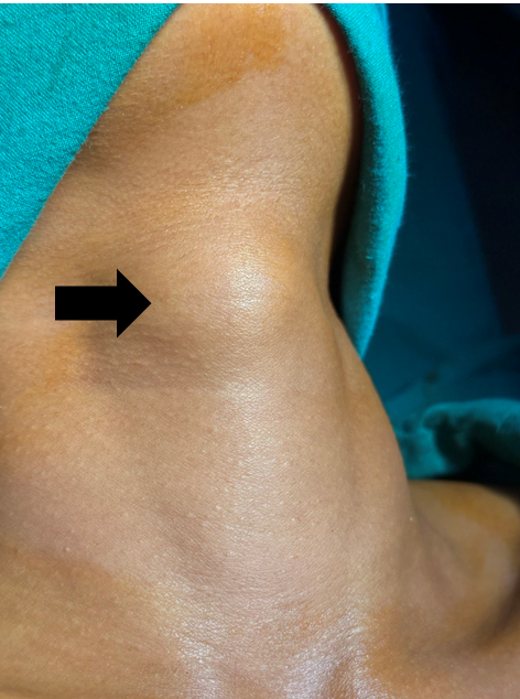 Figure 2: Clinical picture of Thyroglossal duct cyst after neck extension.