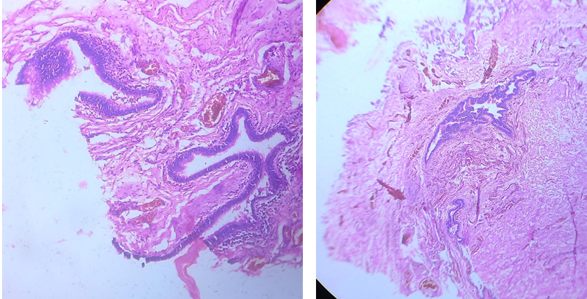 Figure 6: ** (A and B) Histopathological slides.
