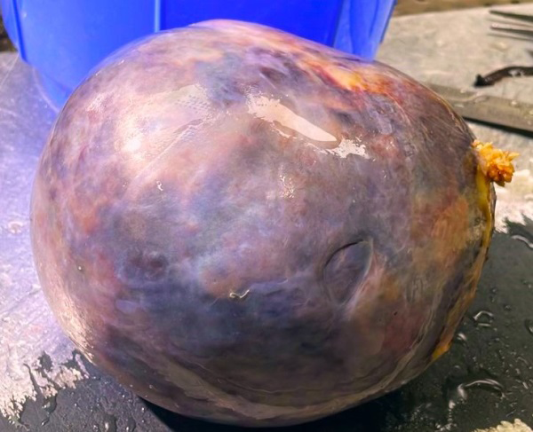 Figure 1: Gross Photographs of the Right Ovarian Mass.