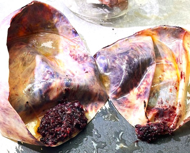 Figure 2: Cut Open Right Ovarian Mass Showing Cystic and Solid Tumor with Papillary Growth.