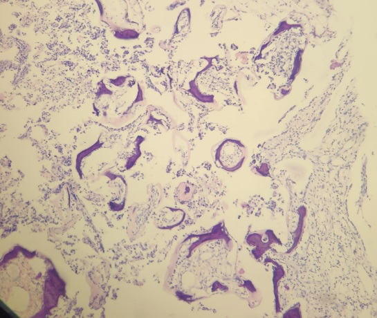 Figure 3: Photomicrograph Showing Serous Papillary Tumor with Osseous Metaplasia (H&E Stain,40x).
