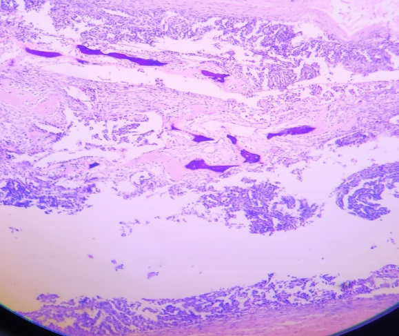 Figure 4: Photomicrograph Showing Serous Papillary Tumor with Osseous Metaplasia (H&E Stain,100x).