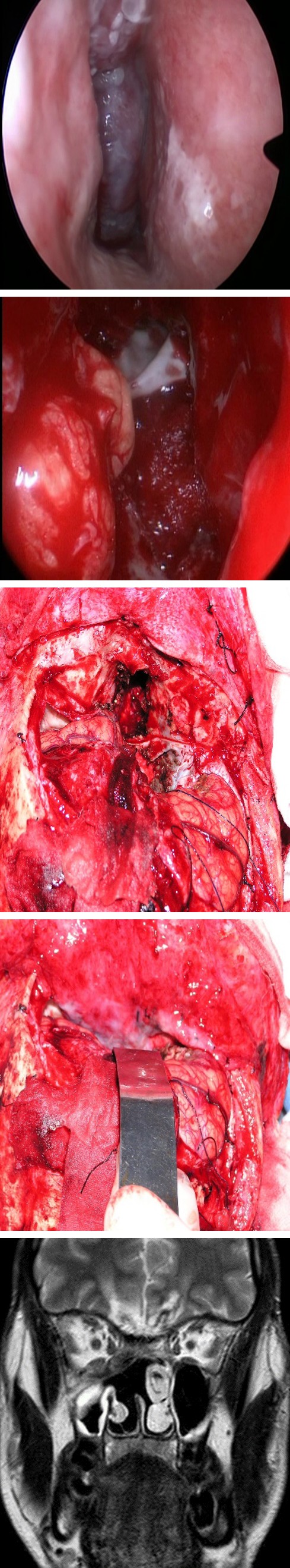 Figure 2: A, B: CT, ENB Located in the Ethmoids without Bony Erosion of the Skull Base is Observed (Kadish B); C: Postoperative MRI.