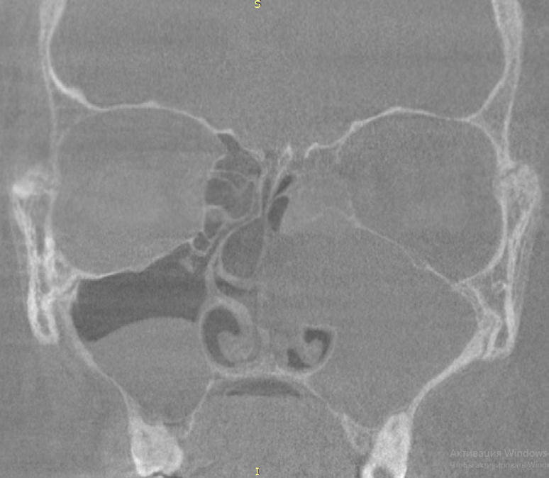Figure 2: Spiral CT, Coronal Axis.