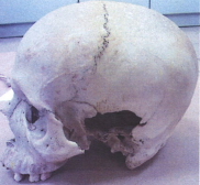 Figure 1: The Piece of Bone and Muscle Sample Recovered from Decomposed Body (Case Study-1, Location 1)