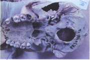 Figure 2: Sample of Muscle Recovered from Decomposed Lower Limb (Case Study-1-Location-2).