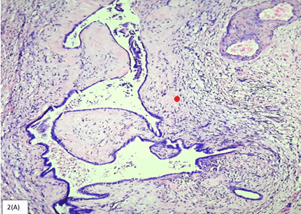 Figure 1: Mucinous cystic neoplasm demonstrating multi-locular cystic spaces layered by cuboidal epithelium surrounded by ovarian type stroma with focal luteinisation [5].