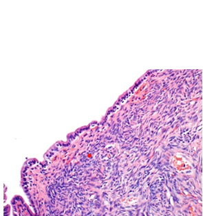 Figure 2: Mucinous cystic neoplasm delineating cystic spaces layered by columnar epithelium encompassed by ovarian type stroma with focal luteinisation and haemorrhage [6].