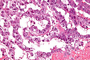 Figure 1: Yolk sac tumour delineating Schiller-Duval bodies with papillary projections into cystic spaces layered with columnar epithelium and centric, vascular structure [6].