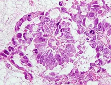 Figure 2: Yolk sac tumour demonstrating Schiller-Duval bodies with papillae confined to cystic spaces and layered with columnar epithelium with a centric vascular structure [7].