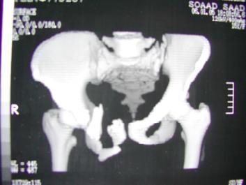 Figure 1: Reconstruction CT in male patient, 32 years old with fracture of superior and anterior pubic rami on right side and dislocation of left sacroiliac joint.