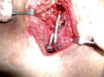 Figure 4: photo after application of the rods on both sides.