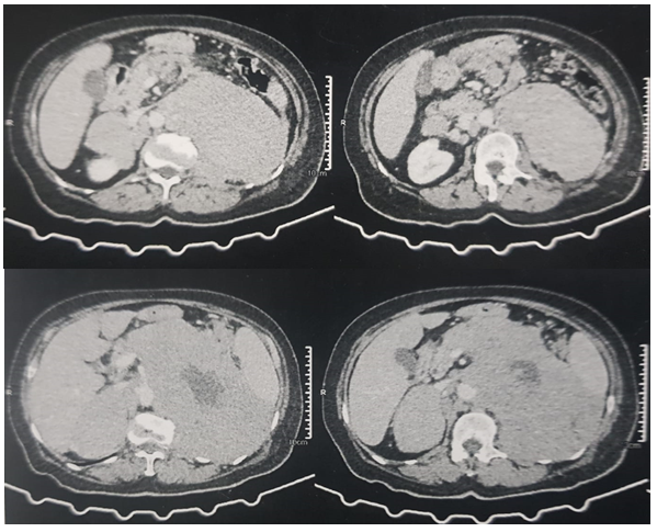 Figure 1: • The left adrenal gland was not seen.