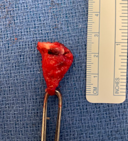 Figure 6: Postoperative Photos after clitoral cystic mass excision and clitoral hood reconstruction At 6 weeks postoperative visit, the patient recovered well and was very satisfied with surgical outcome. Normal anatomy of clitoris/clitoral hoods were noted with normal sensual sensation in/around the clitoris. The patient resumed sexual intercourse without issues. See Figure 6b for the final presentation.
