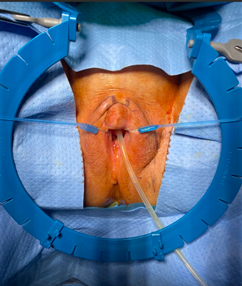 Figure 7: Histologic slides of the clitoral epidermal inclusion cyst.