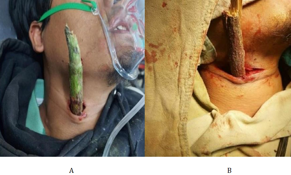 Figure 1: Foreign Body (Wooden) Injury to the Right Anterior Neck. A- At Presentation. B- Intraoperative.