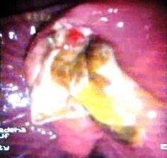 Figure 2: Endoscopic picture showing membranes were seen to be coming out of papilla of Vater.