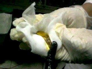 Figure 7: Endoscopic pictures showing removal of membranes from the CBD using Dormia basket.
