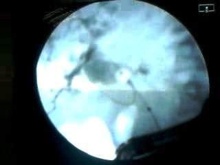 Figure 8: Histopathology; picture of hydatid cyst.