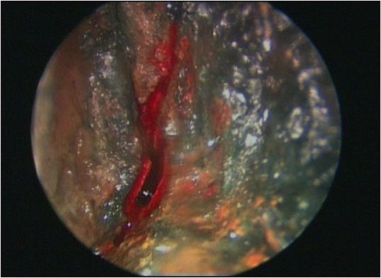 Figure 1: Endoscopic view of the right nasal cavity following removal of a button battery, showing damage to the inferior turbinate, middle turbinate and septum.