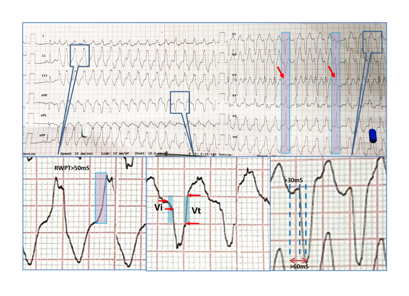 Figure 2: 12-lead electrocardiogram showing regular wide complex tachycardia initiating with PVC after the first sinus beat. Fusion beat (first arrow) and capture beat (next arrow) were present. RWPT was 80mS (>50mS), Vt>Vi in lead aVR. Lead V1 was having LBBB morphology with QRS onset to nadir of S was nearly 110mS. All these morphological criteria point towards ventricular tachycardia. It was case of right ventricular outflow tachycardia on electrophysiological study.
