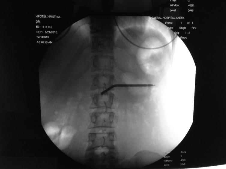 Figure 4: Pelvic radiograph revealing the same metal filling in the right lower quadrant, likely inside the cecum.