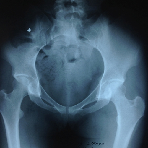 Figure 5: Fluoroscopy image showing a water syringe in the upper left quadrant.