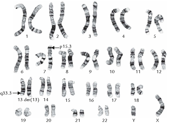 Figure 1: Schematic of the Partial Monosomic Karyotype of Chromosome 7p [1].