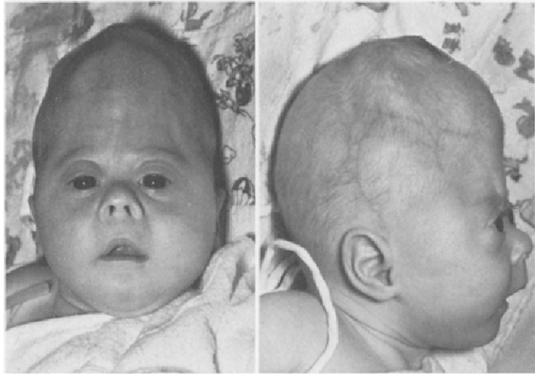 Figure 2: Image of a Baby with Partial Monosomy Syndrome of Chromosome 7p with Related Disorder [1].