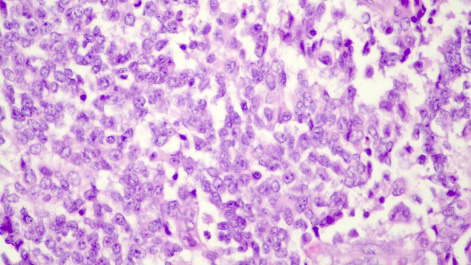 Figure 1: Hepatoblastoma delineating aggregates and trabeculae of immature hepatoblasts impregnated with abundant granular cytoplasm, intracytoplasmic glycogen, miniature nuclei and indistinct nucleoli [5].
