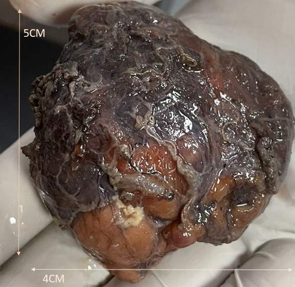 Figure 5: Post-op specimen dorsal surface.