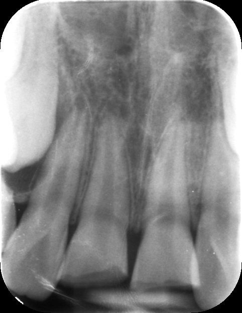 Figure 1: Initial presentation, smile view, showing complicated enamel fracture.