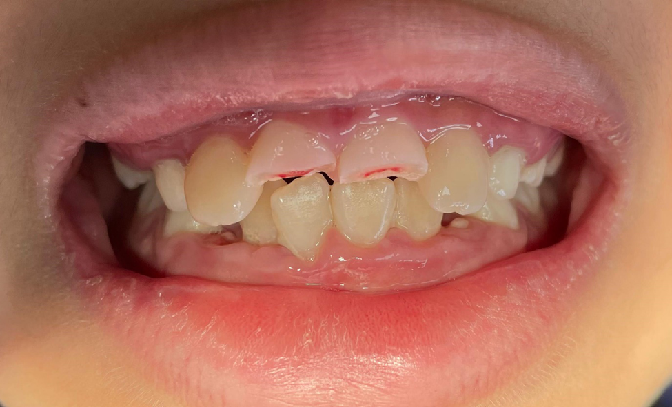 Figure 2: Initial presentation, occlusal view, showing pulpal tissue exposure and bleeding.