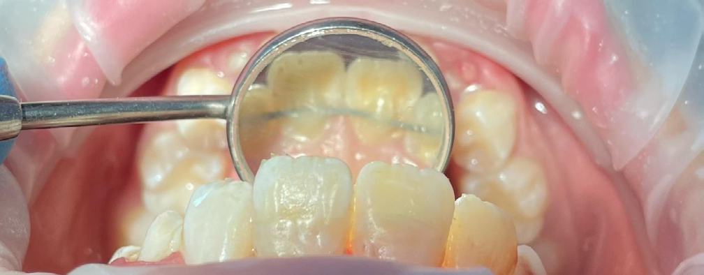 Figure 5: Palatal splint view.