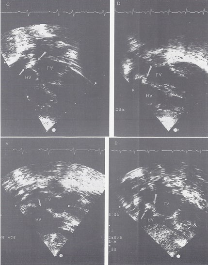 Figure 2: Selected subcostal four-chamber echocardiographic views of the atrial septum, showing a medium-sized atrial septal defect (arrow) prior to device closure (A), shortly after the device implantation (B), and 3 (C) and 6 (D) months following device implantation. The arrow in A shows the atrial septal defect. The large arrows in B, C, and D point to the occluder on the left atrial side and the small arrows in B and C show the counter-occluder end on. LA, Left atrium; RA, right atrium. Reproduced from Rao PS, et al. [10].