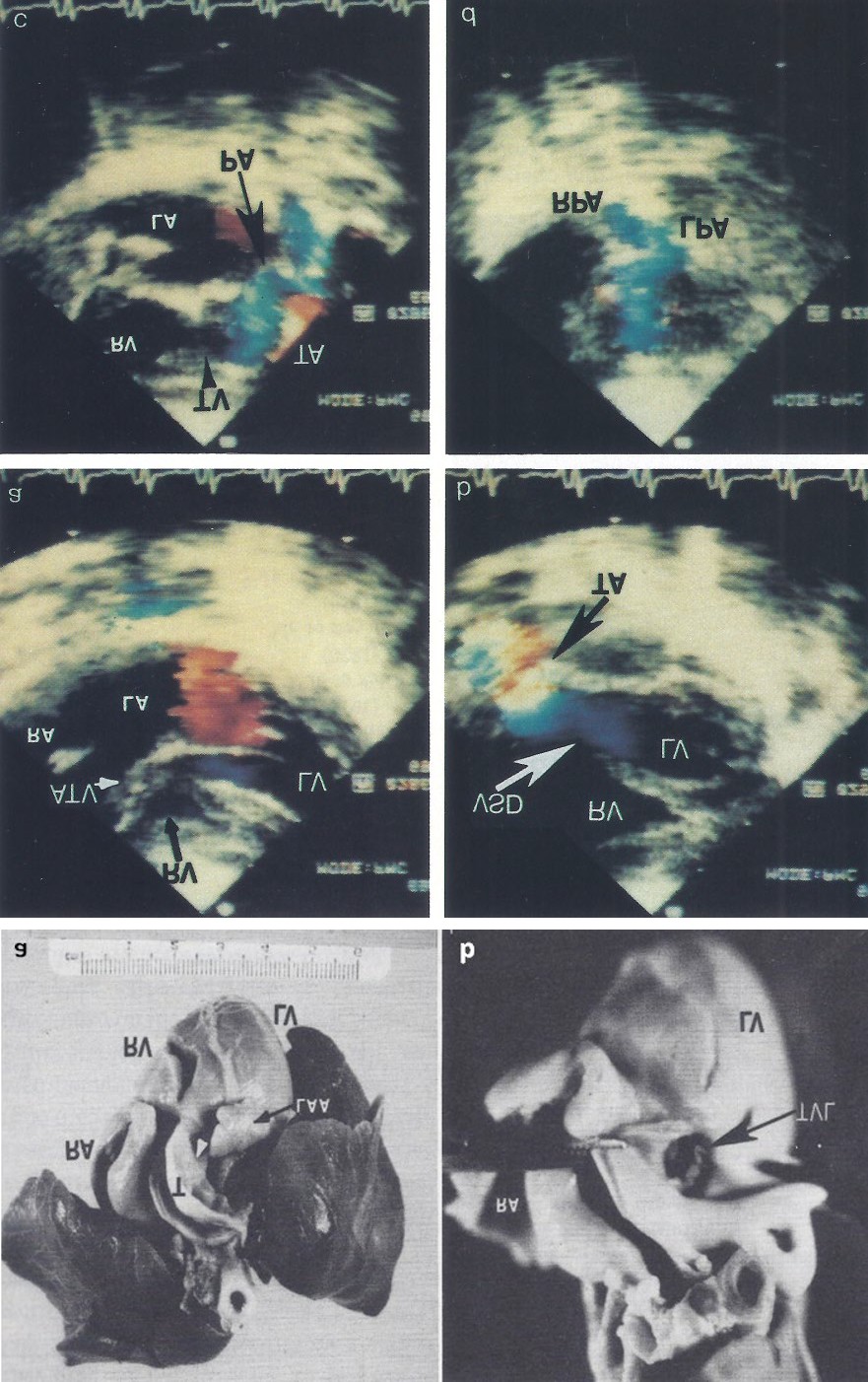 Figure 4: Video frames from a two-dimensional echocardiographic and color Doppler study demonstrating a. an atretic tricuspid valve (ATV) between the right atrium (RA) and right ventricle (RV) and blood flow from the left atrium (LA) into the left ventricle (LV) across the mitral valve. The RV (arrow) is very small and hypoplastic. b. LV and RV with a large ventricular septal defect (VSD) below the Truncus arteriosus (TA). Turbulent flow across the truncal valve suggests truncal valve stenosis. c. the origin of the pulmonary artery (PA) from the TA by color flow (arrow), and d. the division of right (RPA) and left (LPA) pulmonary arteries from the PA (not labeled in d) in a short-axis view. TV, truncal valve leaflets. Reproduced from Rao PS, et al. [14].